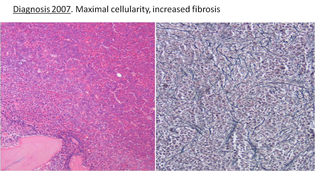Fig 1. Bone marrow biopsy at diagnosis